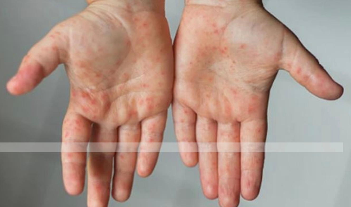 হামের প্রকোপ কবে কমতে পারে?